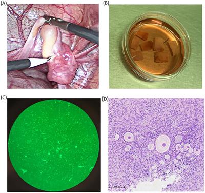 Ovarian tissue cryopreservation after graft failure of allogeneic hematopoietic stem cell transplantation: first report and literature review